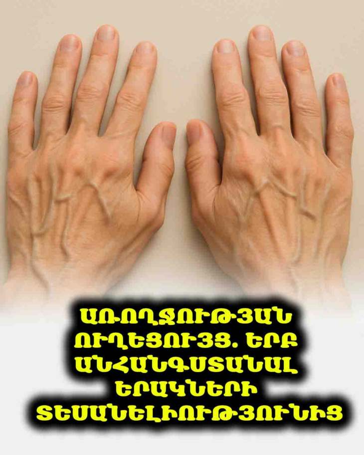 🤔 Ձեր երակները շա՞տ են նկատելի։ Միշտ չէ, որ անհանգստանալու պատճառ կա, բայց որոշ դեպքերում սա կարևոր նշան է։