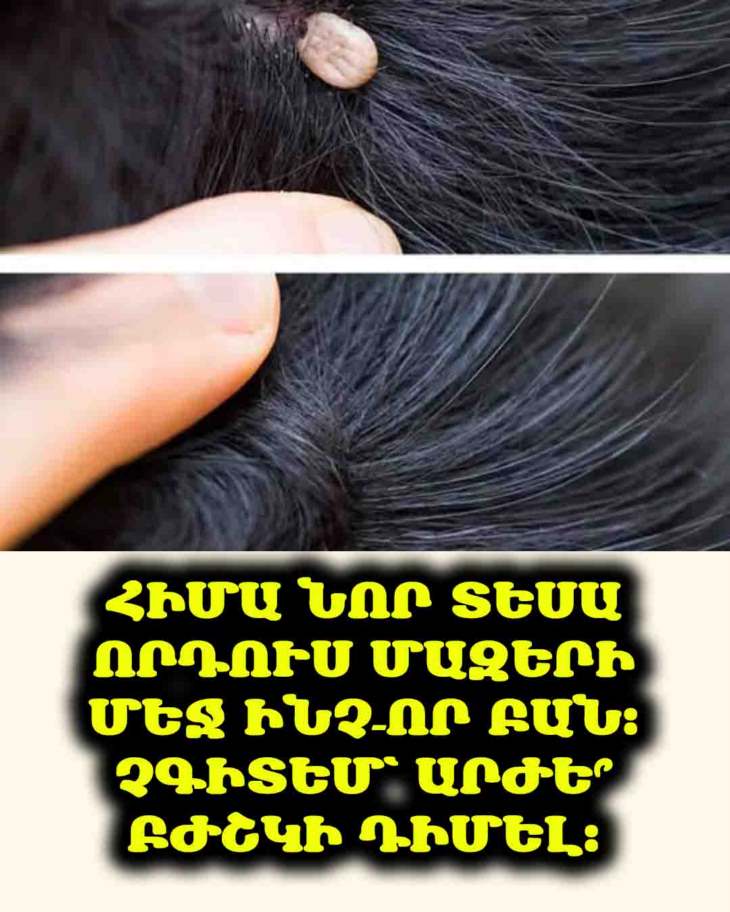 👧🏻👦🏻 Հիմա նոր տեսա որդուս մազերի մեջ ինչ–որ բան։ Չգիտեմ՝ արժե՞ բժշկի դիմել։