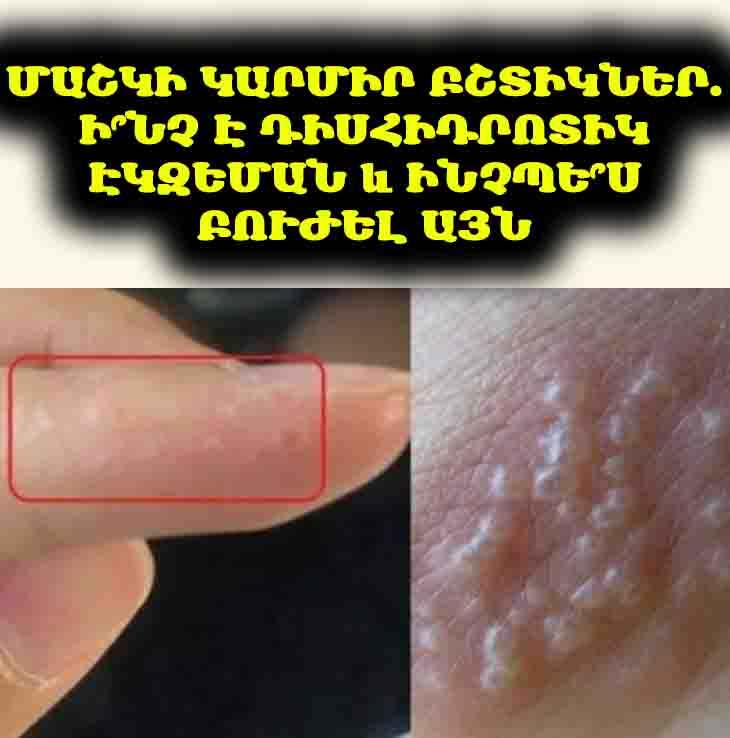 🚨 Ձեռքերի և ոտքերի վրա ցավոտ կարմիր բշտիկներ ունե՞ք։ Հնարավոր է՝ դա դիսհիդրոտիկ էկզեմա է: