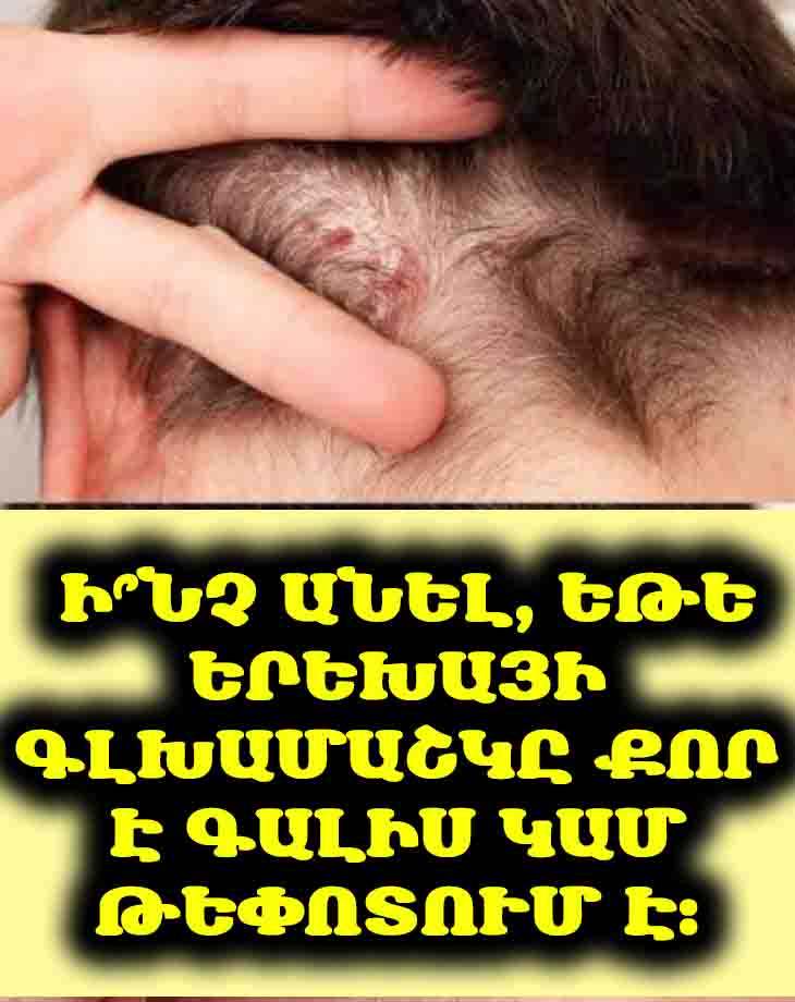 🤔 Ես սա գտել եմ իմ որդու գլխամաշկի վրա։ Ես ընդհանրապես չգիտեմ՝ սա ինչ է, և մենք չենք կարող շուտ այցելել բժշկին։ Կա՞ն որևէ խորհուրդներ։