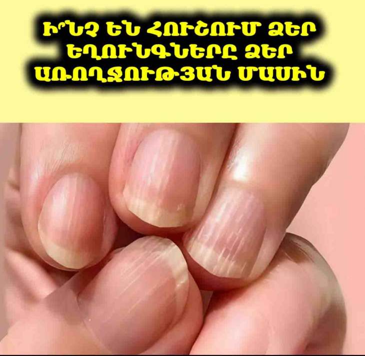 💅 Ի՞նչ են հուշում ձեր եղունգները առողջության մասին. Գծեր և Ակոսներ