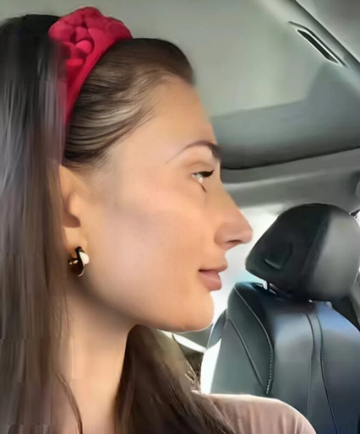 👃📲💖 Տարիներ շարունակ նա երազում էր կատարյալ քթի մասին, որը վստահություն կպարգևեր։ Եվ ահա, վերջապես, նա որոշեց դիմել ռինոպլաստիկայի՝ մի քայլ, որը փոխեց ոչ միայն արտաքինը, այլև ներքին աշխարհը։