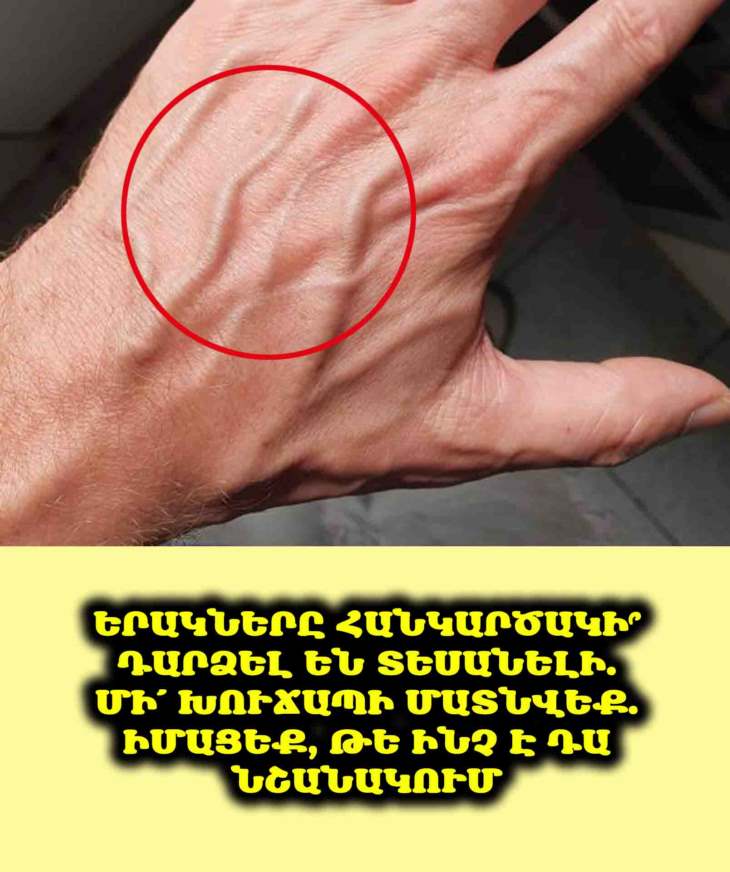 🚨 Երակները հանկարծակի՞ դարձել են տեսանելի. Մի՛ խուճապի մատնվեք. իմացեք, թե ինչ է դա նշանակում