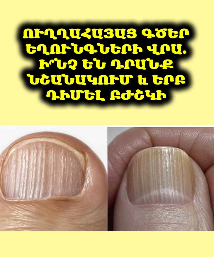 🤔 Ձեր եղունգների վրա ուղղահայաց գծեր կա՞ն. Միգուցե սա ձեր օրգանիզմի ազդանշանն է։
