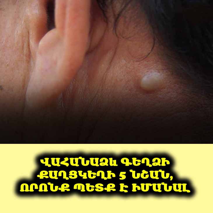 🦋 Արդյո՞ք ձեր պարանոցում նոր գոյացություն կա։ Իմացեք վահանաձև գեղձի քաղցկեղի 5 վաղ նշանների մասին։