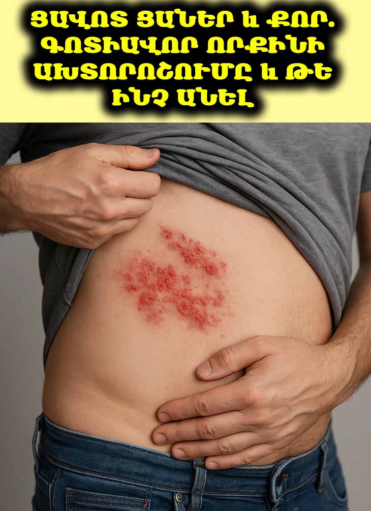 😖 Ցավոտ ցաներ և քոր. Գոտիավոր որքինի ախտորոշումը և թե ինչ անել