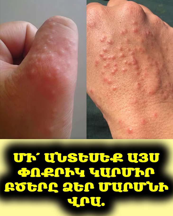 ⚠️ Շատ կարևոր է իմանալ։ Մարմնի վրա փոքրիկ կարմիր բծերը կարող են քոսի նշաններ լինել։ Բացահայտեք ախտանշանները և մի՛ անտեսեք դրանք։