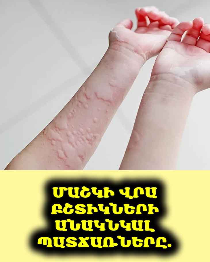 Մաշկի վրա բշտիկների անակնկալ պատճառները. Ի՞նչը կարող է առաջացնել ձեր մաշկի ռեակցիան