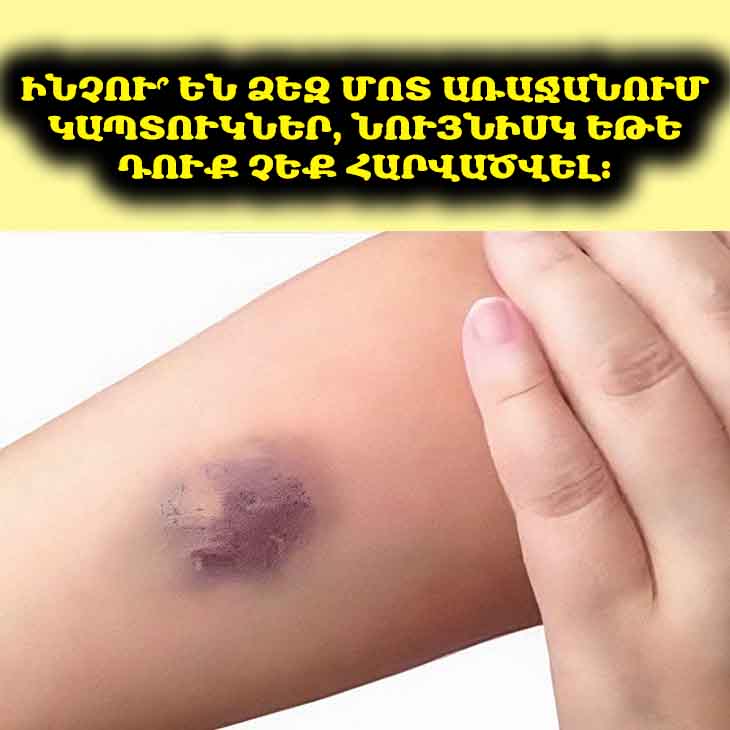 🤔 Զարմանալի է, բայց փաստ. կապտուկներ կարող են առաջանալ նաև առանց հարվածի։ Ինչո՞ւ է դա տեղի ունենում։