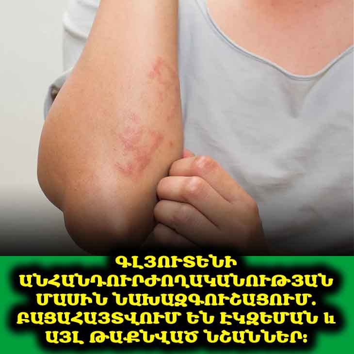🤕 Գլխացավեր, հոգնածություն, փքվածություն. այս բոլորը կարող են գլյուտենի պատճառով լինել։ Իմացեք՝ ինչպես ճանաչել նշանները։