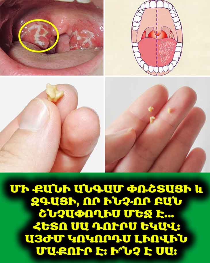 Մի քանի անգամ փռշտացի և զգացի, որ ինչ-որ բան շնչափողիս մեջ է... Հետո սա դուրս եկավ։ Այժմ կոկորդս լիովին մաքուր է։ Ի՞նչ է սա։