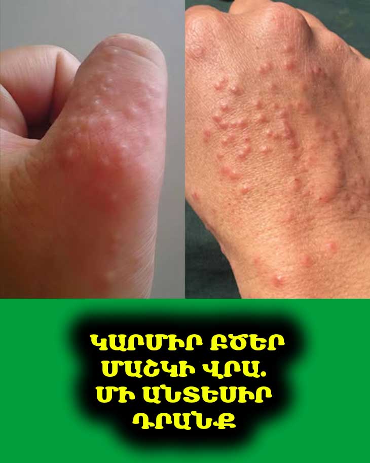 Մի անտեսիր այս փոքրիկ կարմիր բծերը ձեր ձեռքի վրա. դրանք կարևոր նախազգուշացնող նշաններ կարող են լինել