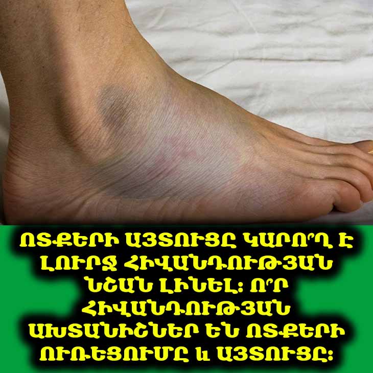 🦵 Ոտքերի այտուցը կարո՞ղ է լուրջ հիվանդության նշան լինել: Ո՞ր հիվանդության ախտանիշներ են ոտքերի ուռեցումը և այտուցը։