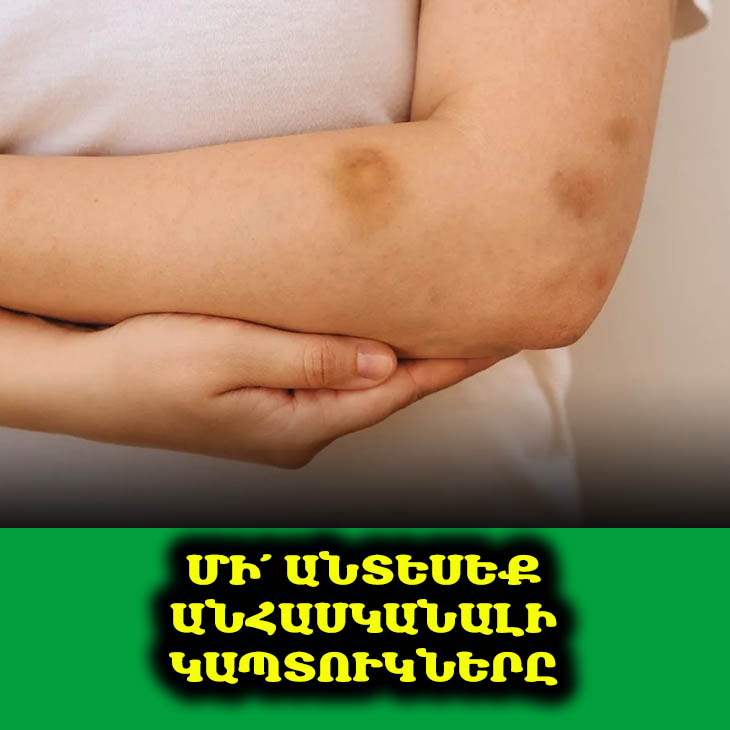 🤕 Կապտուկներն առանց պատճառի. Արդյո՞ք դա նորմալ է։ Բացահայտեք թաքնված պատճառները։