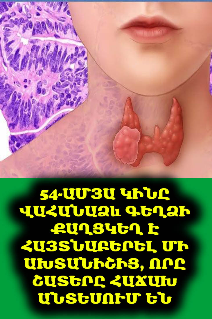 🚨 Մի՛ անտեսեք պարանոցի փոքրիկ գունդը. Այն կարող է վահանաձև գեղձի քաղցկեղի նշան լինել: