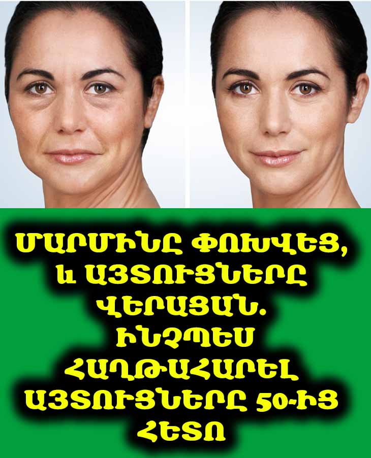 Փոխեցի իմ մոտեցումը, և հեղուկը վերացավ. ինչպե՞ս ամբողջությամբ ազատվել այտուցներից դեմքի և մարմնի վրա