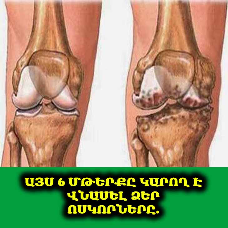 🦴 6 սննդամթերք, որոնք լուռ քայքայում են կալցիումը մարմնից․ որքան շատ եք ուտում, այնքան թուլանում են ձեր ոսկորները
