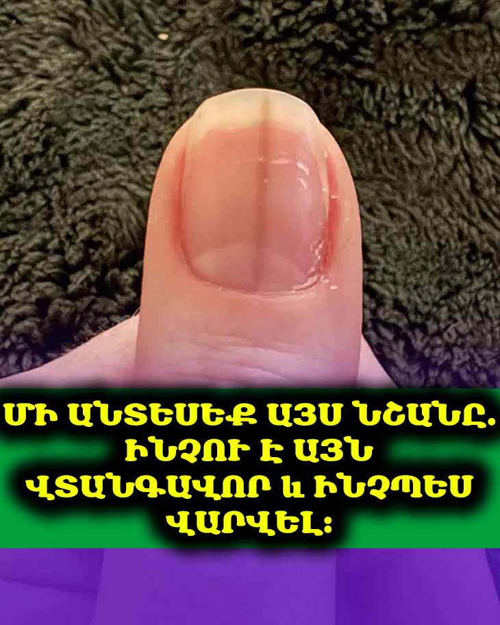 Կինը ստիպված է եղել անմիջապես դիմել բժշկի՝ համացանցում բութ մատի նկարը հրապարակելուց հետո։