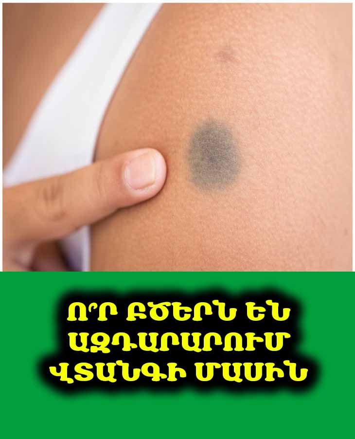 Ո՞ր մաշկային բծերն են անհապաղ բուժզննում պահանջում