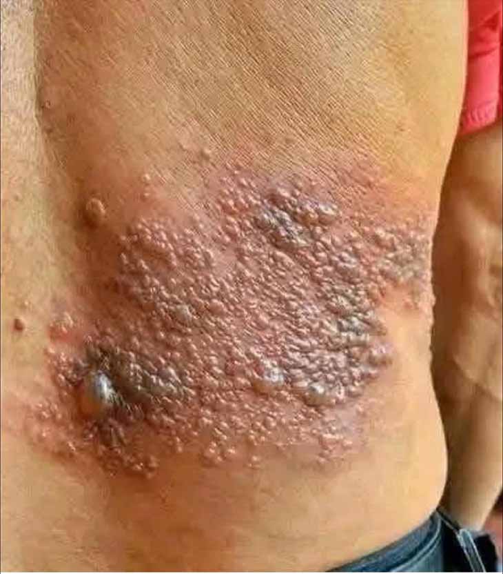 Դա ալերգիա չէր. նրա ամբողջ մարմինը քոր էր գալիս, բայց բարդ ախտորոշումը ցույց տվեց, որ&hellip;