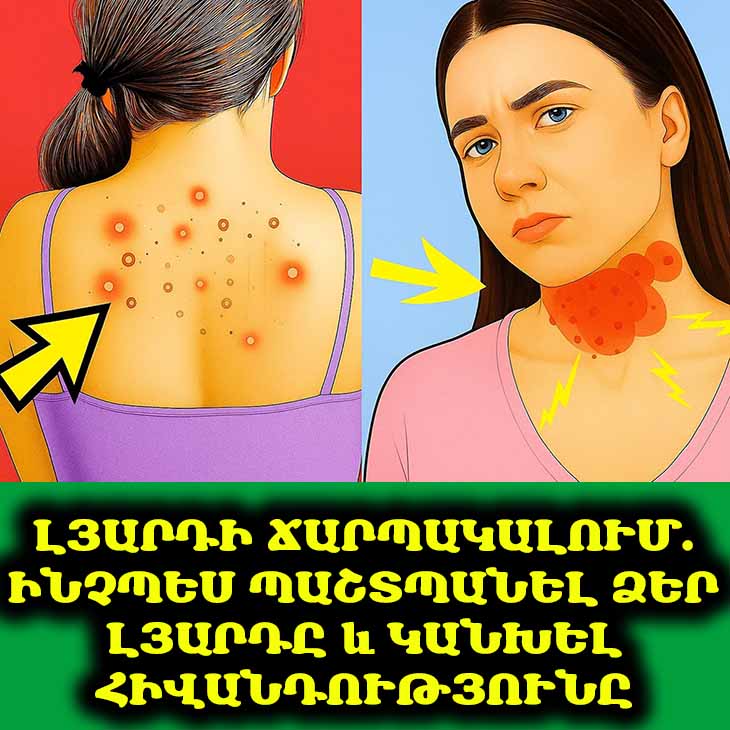 Լյարդի ճարպակալում․ նախազգուշական նշաններ և բուժում։ Հիմնական փաստեր, որոնք բժիշկները ցանկանում են, որ դուք իմանաք