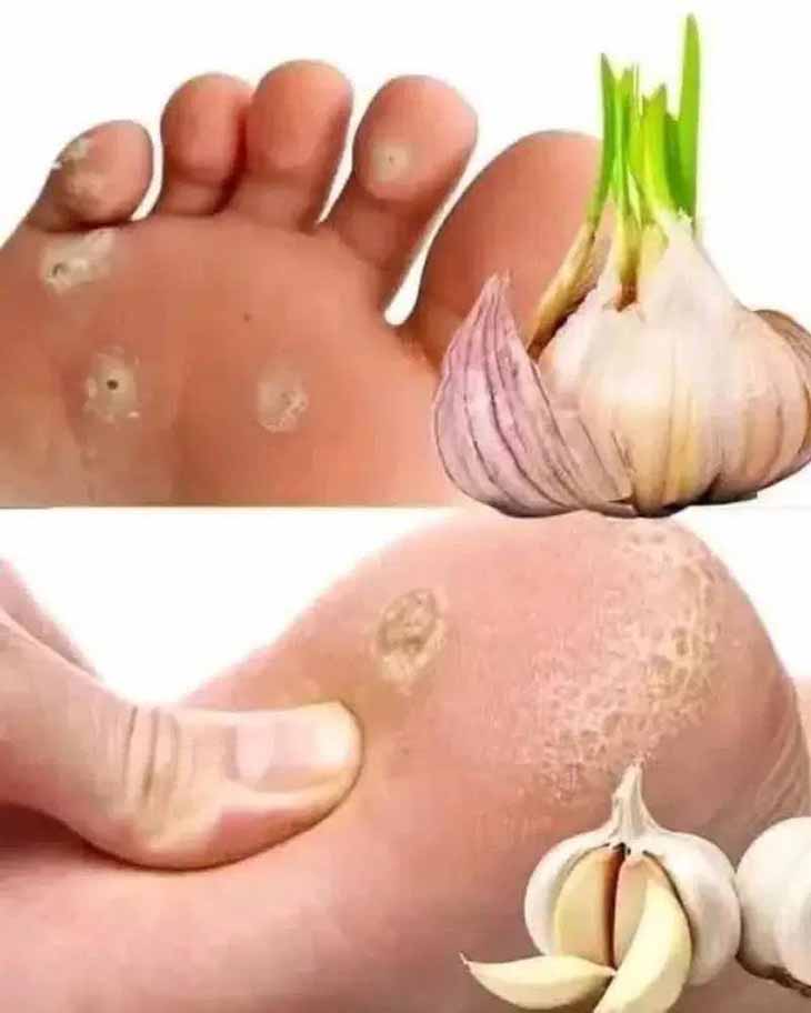 Ոտքերի վրա հիվանդությունների ախտանշաններ և դրանց բուժման բնական միջոցներ