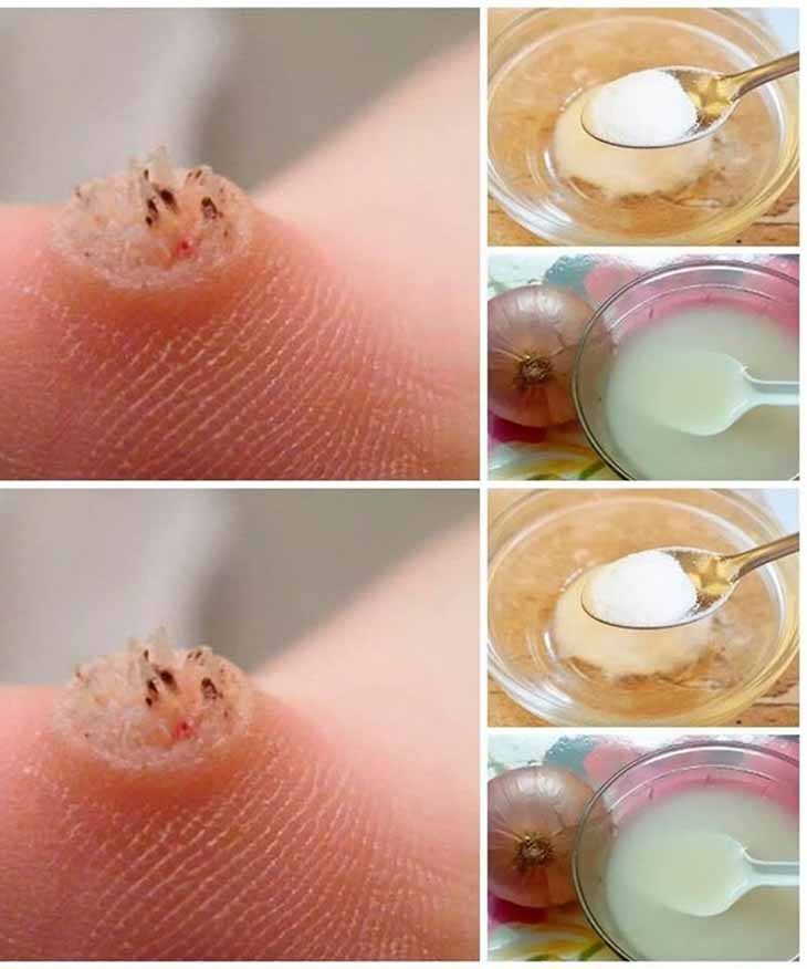 Բնական միջոցներ՝ գորտնուկները հեռացնելու համար