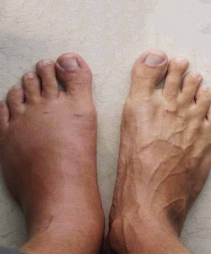 🦶 Ոտքերի այտուցը անտեսո՞ւմ եք։ Դադարեք դա անել։ Սա կարող է լինել ձեր առողջության մասին լուրջ նախազգուշացում։