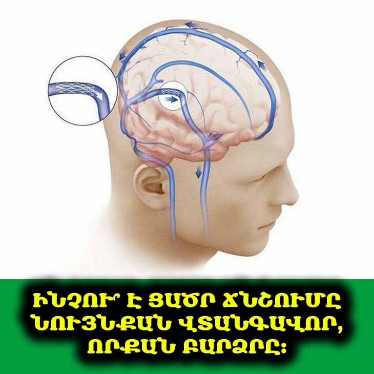 Ինչու՞ է ցածր ճնշումը վտանգավոր և ինչպե՞ս այն բարձրացնել առանց սուրճի ☕