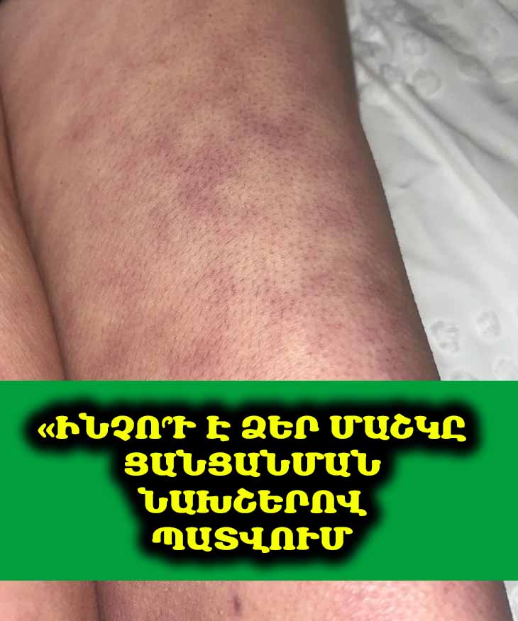 🌡️ Մաշկի վրա տարօրինակ նախշե՞ր եք նկատում: Պարզեք, թե ինչ կարող է դա նշանակել ձեր առողջության համար: