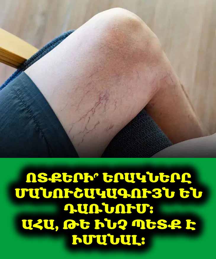 🦶 Ոտքերի երակները մանուշակագո՞ւյն են. Ինչու՞ է դա տեղի ունենում և ի՞նչ անել:
