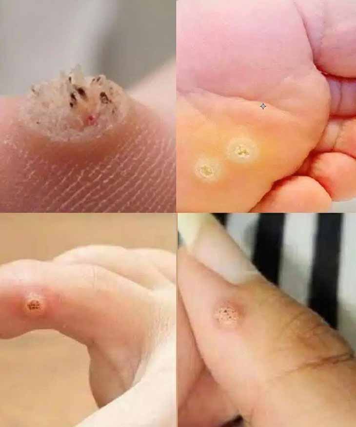 😲‼️ Զգուշացե՛ք, եթե նկատում եք այս մաշկային գոյացությունը, այն կարող է լուրջ լինել