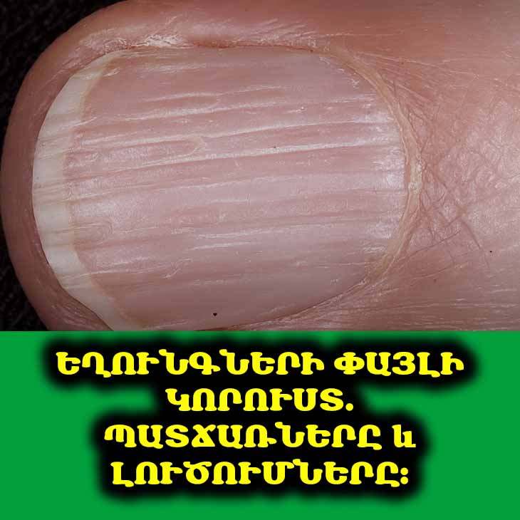 💅 Եղունգներն ազդանշան են տալիս. ի՞նչ են նշանակում ակոսավոր ու անփայլությունը: