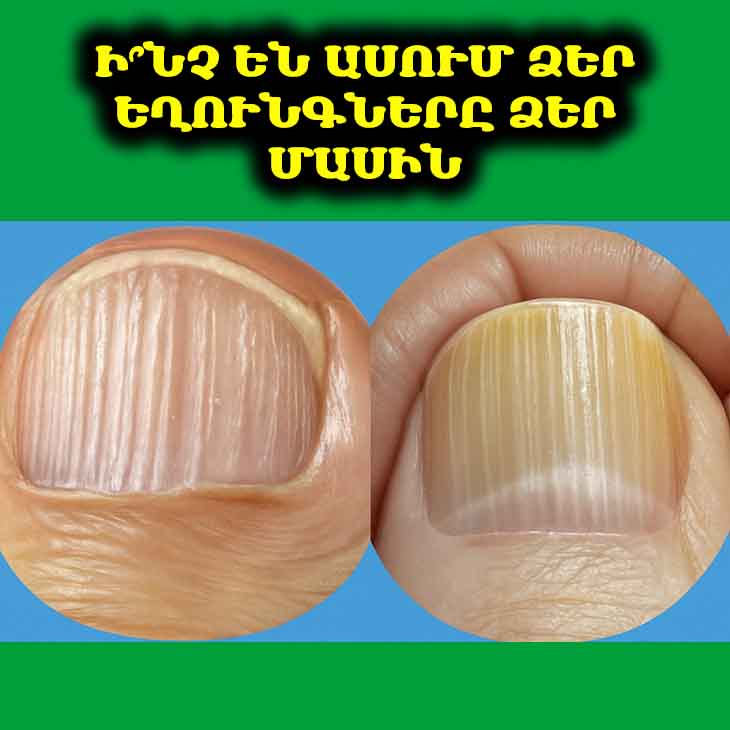 Եթե Ձեր Եղունգներին Նման Շերտեր Կան. Ի՞նչ Կարող Են Դրանք Նշանակել 💅🔬