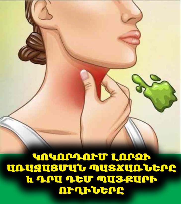 Կոկորդում լորձի առաջացման պատճառները և դրա դեմ պայքարի ուղիները 🗣️