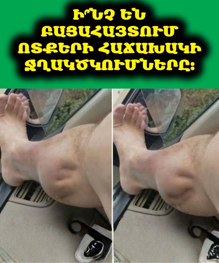 Ի՞նչ են բացահայտում ոտքերի ջղակծկումները երիկամների ձեր առողջության մասին: 🦵🔬