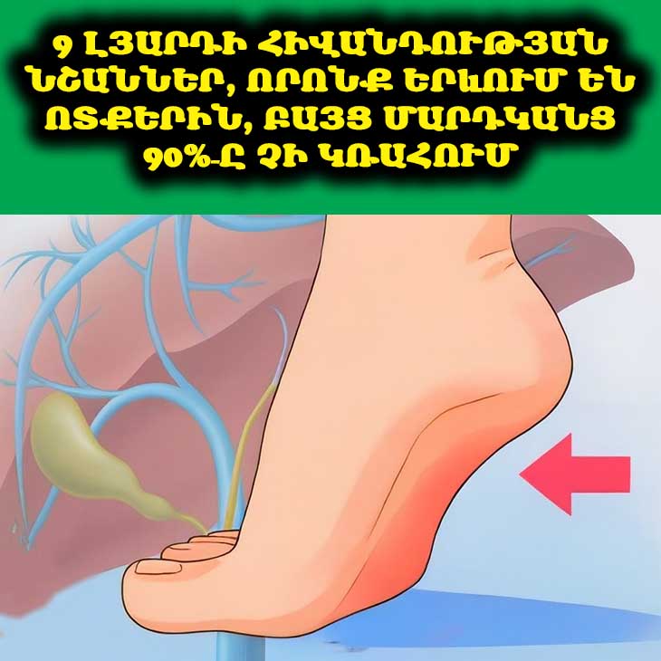 9 Լյարդի Հիվանդության Նշաններ, Որոնք Երևում Են Ոտքերին, Բայց Մարդկանց 90%&ndash;ը Չի Կռահում 🦶