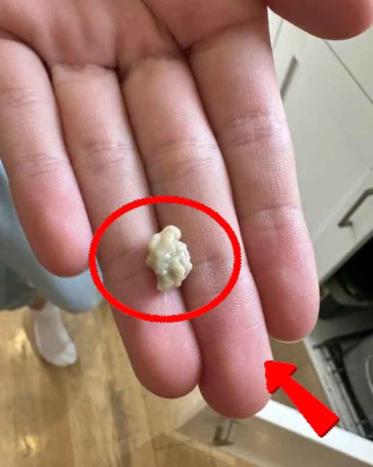 Ամեն ինչ, ինչ պետք է իմանալ նշիկների քարերի մասին․ այս տարօրինակ գոյացությունները նման են կոկորդի պզուկների 😲🤢🩺